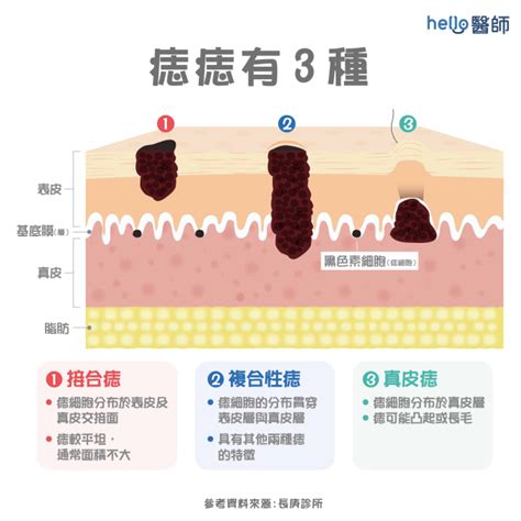 為何會長痣|痣變大、痣多或長毛會變皮膚癌？認識痣的形成與原因